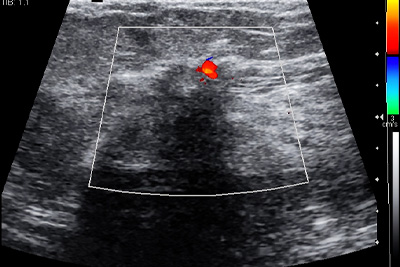 breast ultrasound