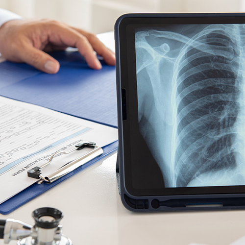 Who should consider a lung cancer screening?