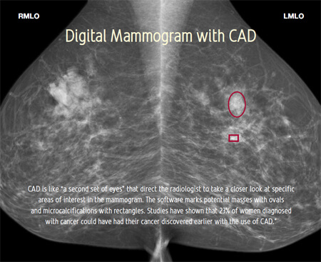 breast cancer digital mammogram