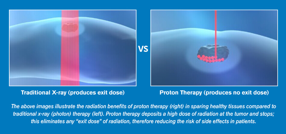 X-Ray vs Proton Therapy